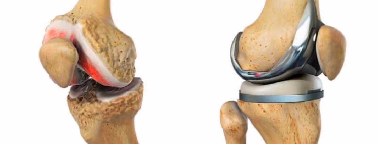 ¿Cómo puede ayudar la inteligencia artificial al diseño de prótesis?